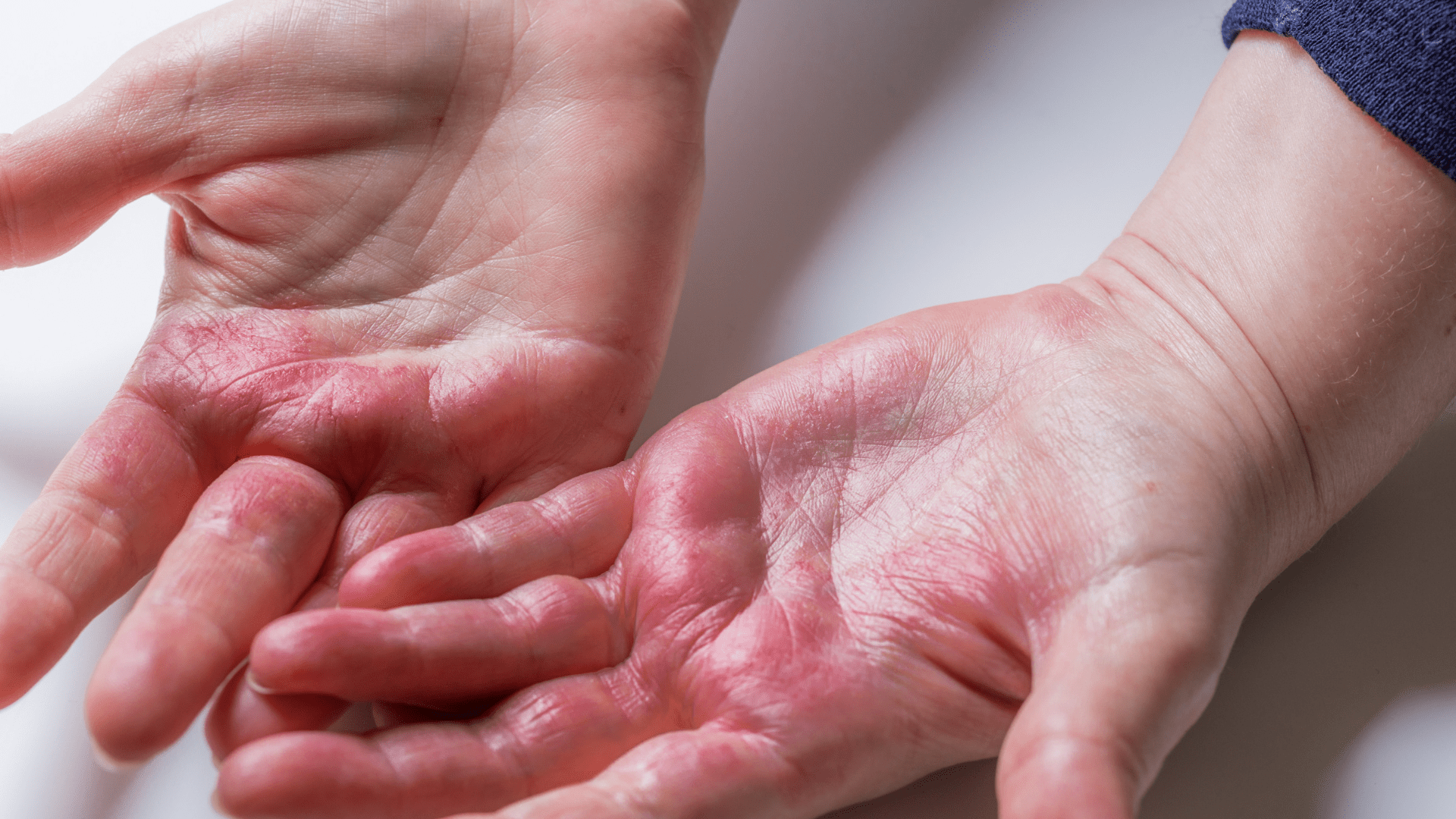 Eczema on your hands? This tips could help!👋 - Scrachee