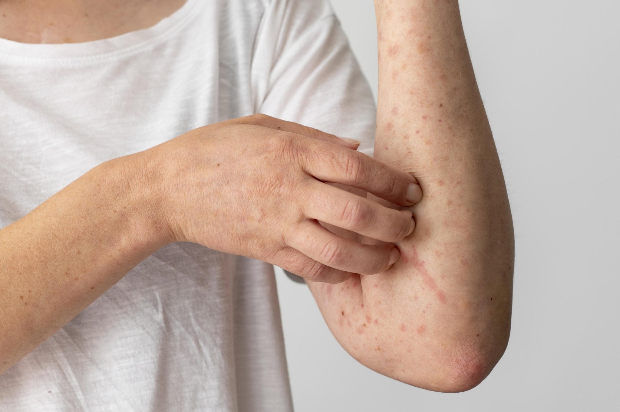 Can eczema go away? - Scrachee