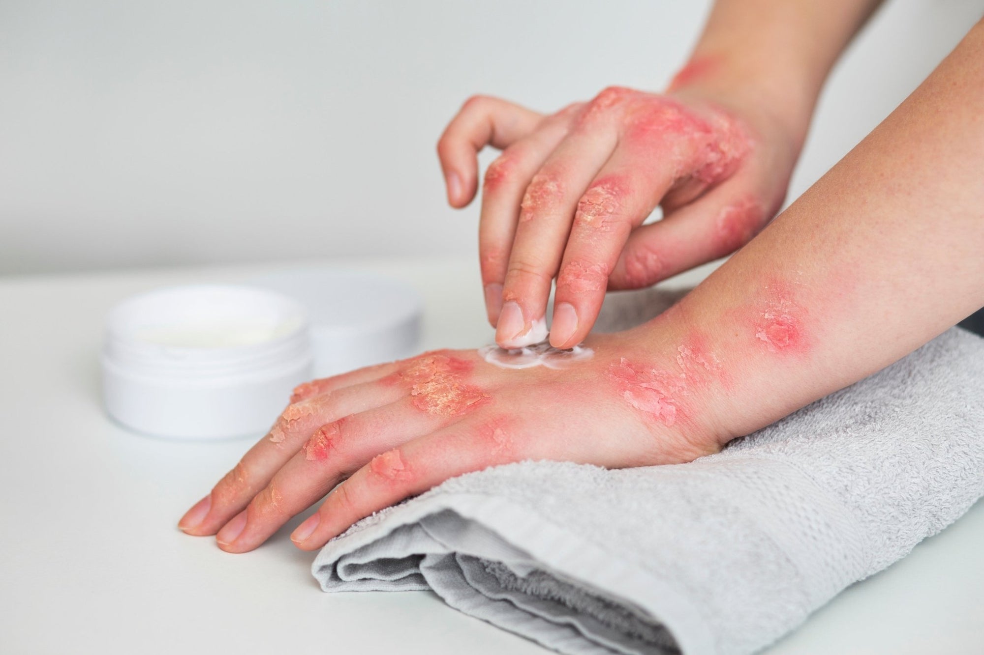 When to Stop Using Topical Steroids: 4 Key Signs - Scrachee